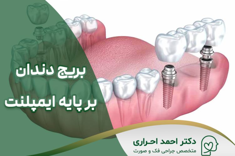 بریج بر پایه ایمپلنت
