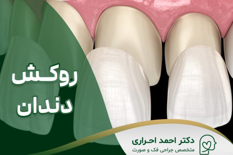 روکش دندان در تهران