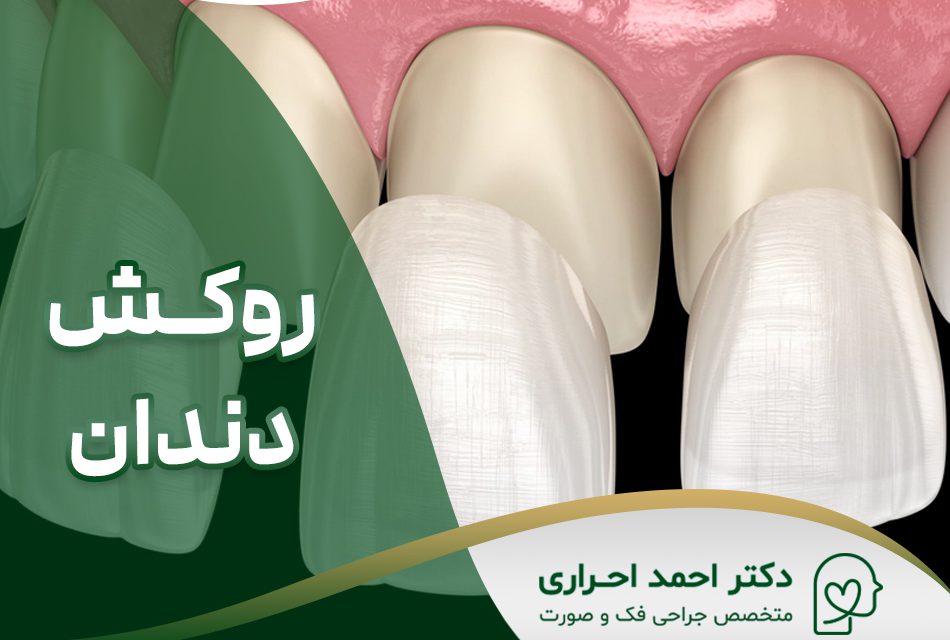 روکش دندان در تهران